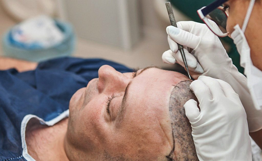 Your Number One Hair Transplant Surgeon