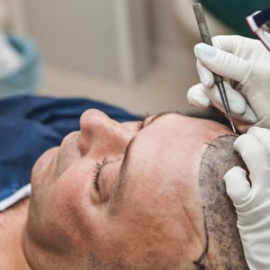 Your Number One Hair Transplant Surgeon