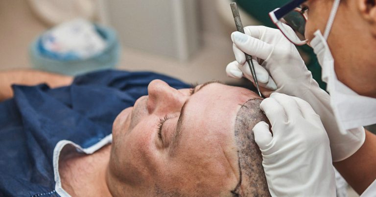 Your Number One Hair Transplant Surgeon