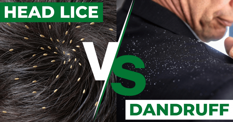 Head Lice: Expectations vs. Reality